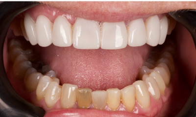 Before treatment - Veneers